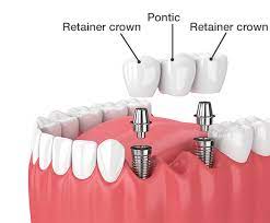 implant